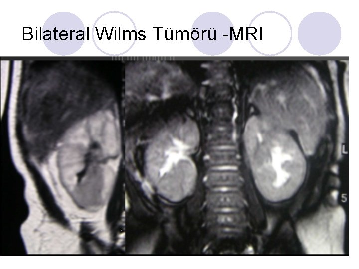 Bilateral Wilms Tümörü -MRI Bilateral Wilms Tümörü -MRI