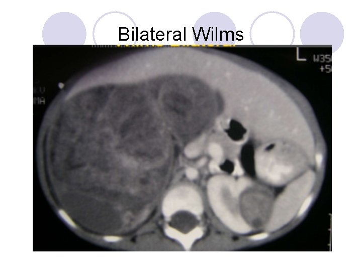 Bilateral Wilms Bilateral Wilms