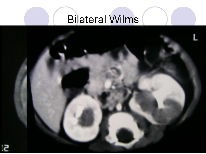 Bilateral Wilms Bilateral Wilms