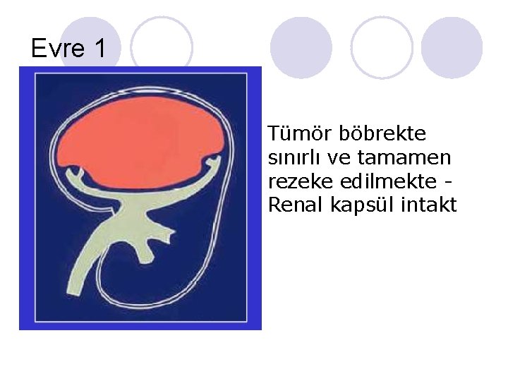 Evre 1 Tümör böbrekte sınırlı ve tamamen rezeke edilmekte Renal kapsül intakt Evre 1 Tümör böbrekte sınırlı ve tamamen rezeke edilmekte Renal kapsül intakt