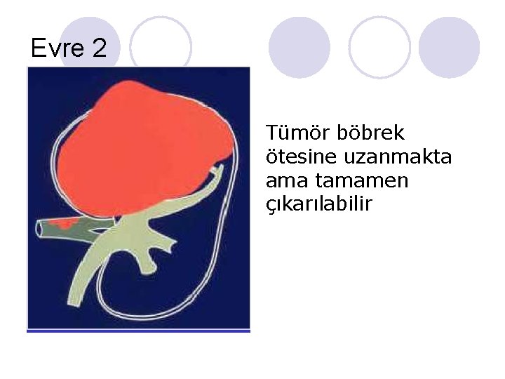 Evre 2 Tümör böbrek ötesine uzanmakta ama tamamen çıkarılabilir Evre 2 Tümör böbrek ötesine uzanmakta ama tamamen çıkarılabilir