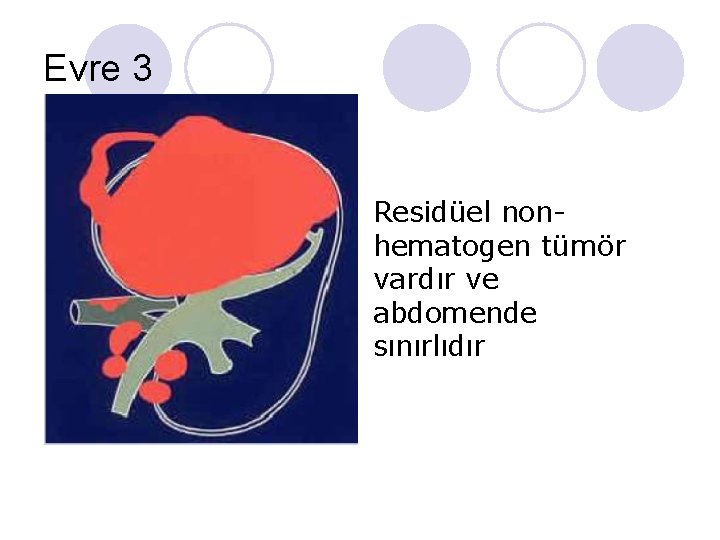 Evre 3 Residüel nonhematogen tümör vardır ve abdomende sınırlıdır Evre 3 Residüel nonhematogen tümör vardır ve abdomende sınırlıdır