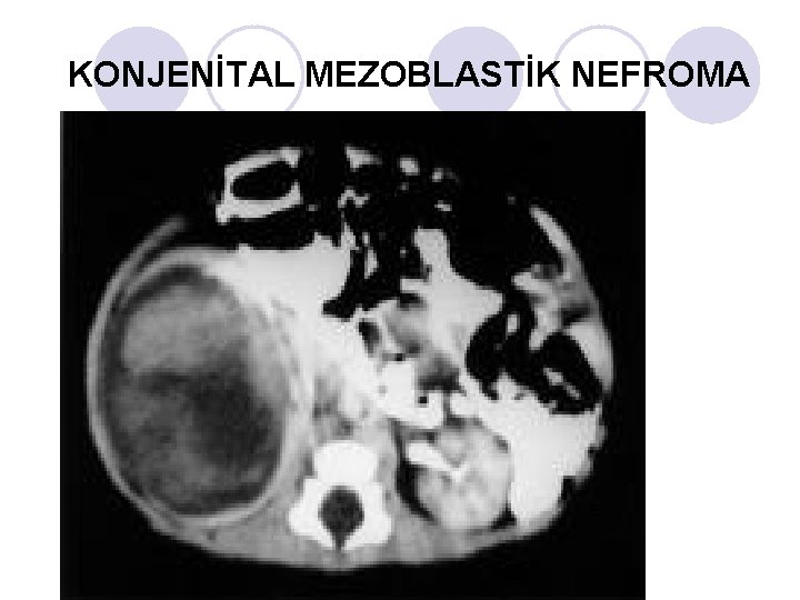 KONJENİTAL MEZOBLASTİK NEFROMA KONJENİTAL MEZOBLASTİK NEFROMA