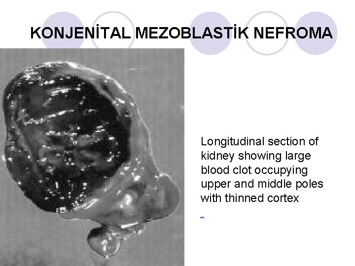 KONJENİTAL MEZOBLASTİK NEFROMA Longitudinal section of kidney showing large blood clot occupying upper and KONJENİTAL MEZOBLASTİK NEFROMA Longitudinal section of kidney showing large blood clot occupying upper and