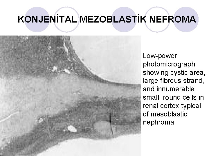 KONJENİTAL MEZOBLASTİK NEFROMA Low-power photomicrograph showing cystic area, large fibrous strand, and innumerable small, KONJENİTAL MEZOBLASTİK NEFROMA Low-power photomicrograph showing cystic area, large fibrous strand, and innumerable small,