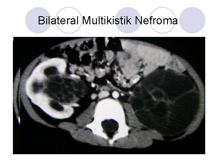 Bilateral Multikistik Nefroma Bilateral Multikistik Nefroma
