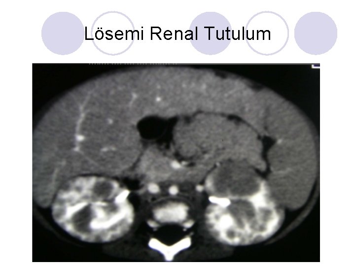 Lösemi Renal Tutulum Lösemi Renal Tutulum