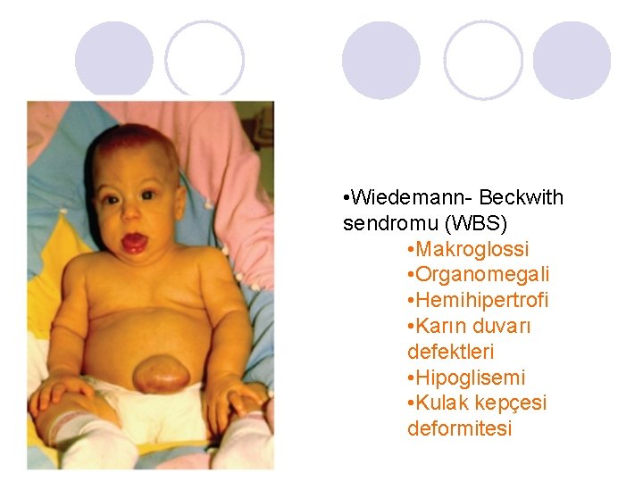 • Wiedemann- Beckwith sendromu (WBS) • Makroglossi • Organomegali • Hemihipertrofi • Karın • Wiedemann- Beckwith sendromu (WBS) • Makroglossi • Organomegali • Hemihipertrofi • Karın