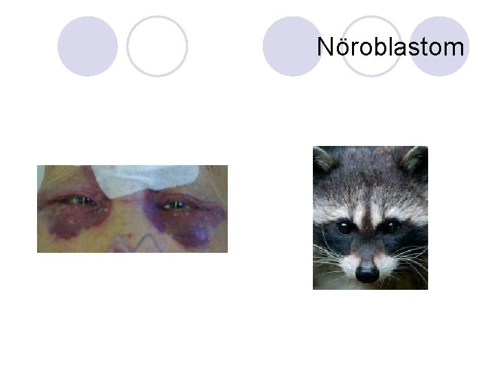 Nöroblastom Nöroblastom