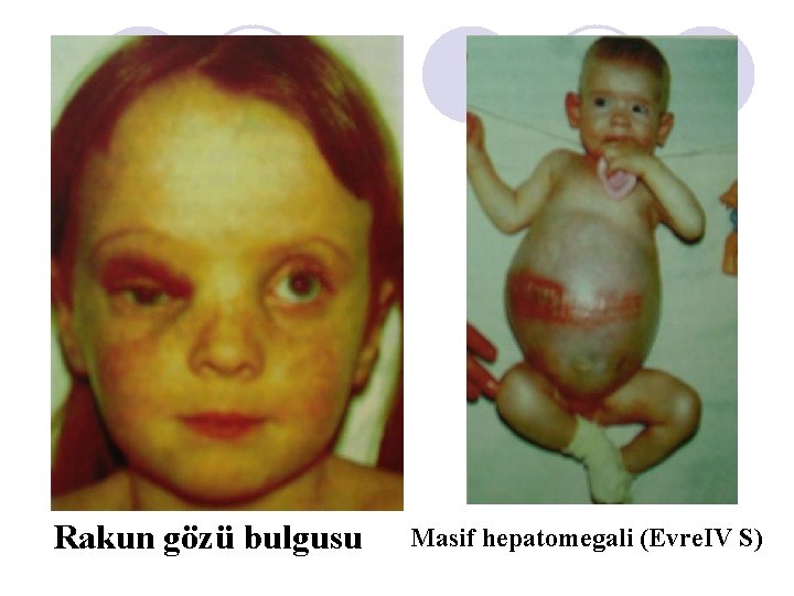 Rakun gözü bulgusu Masif hepatomegali (Evre. IV S) Rakun gözü bulgusu Masif hepatomegali (Evre. IV S)