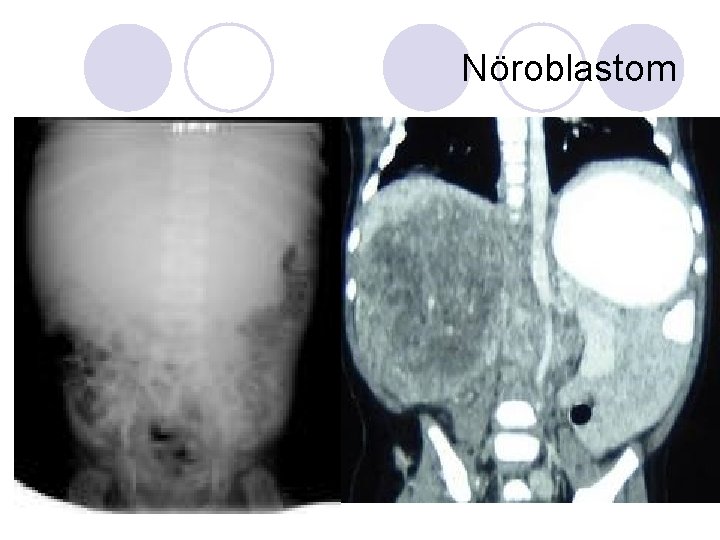 Nöroblastom Nöroblastom