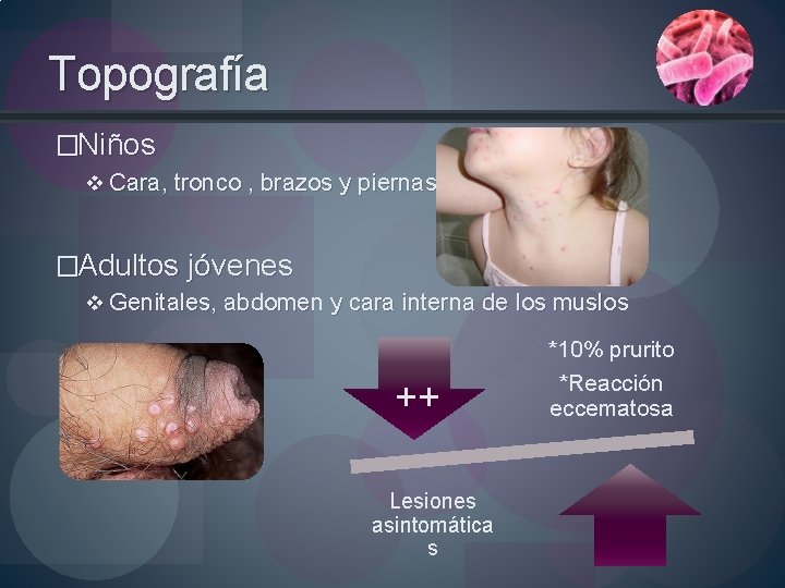 Topografía �Niños v Cara, tronco , brazos y piernas �Adultos jóvenes v Genitales, abdomen