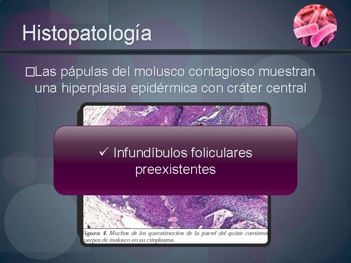 Histopatología �Las pápulas del molusco contagioso muestran una hiperplasia epidérmica con cráter central ü