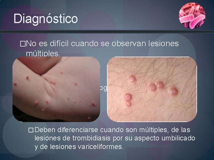 Diagnóstico �No es difícil cuando se observan lesiones múltiples. �Lesión única: �Simula granuloma piogénico,