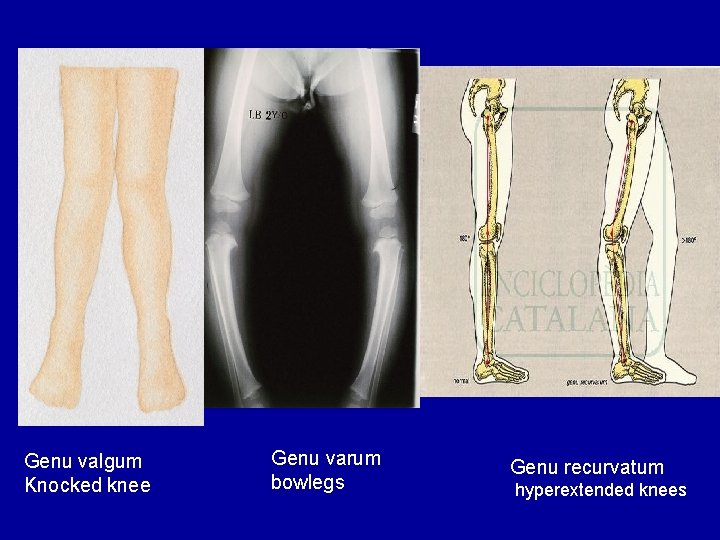 Genu valgum Knocked knee Genu varum bowlegs Genu recurvatum hyperextended knees 