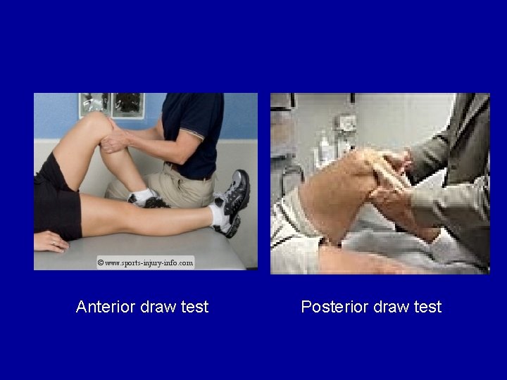 Anterior draw test Posterior draw test 