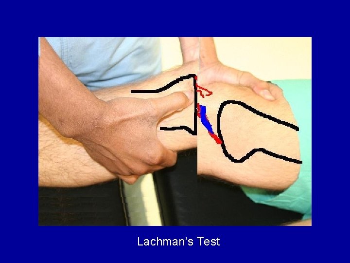 Lachman’s Test 