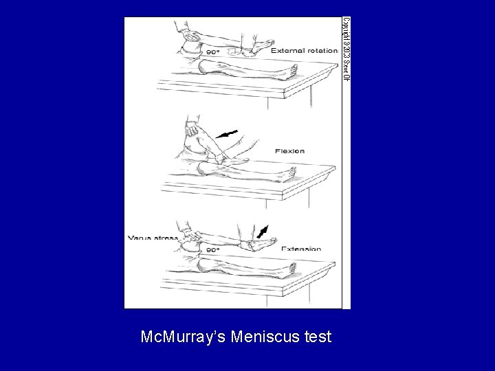 Mc. Murray’s Meniscus test 