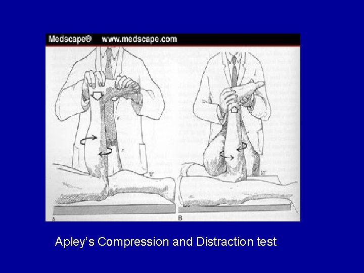 Apley’s Compression and Distraction test 