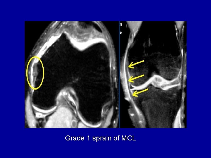 Grade 1 sprain of MCL 