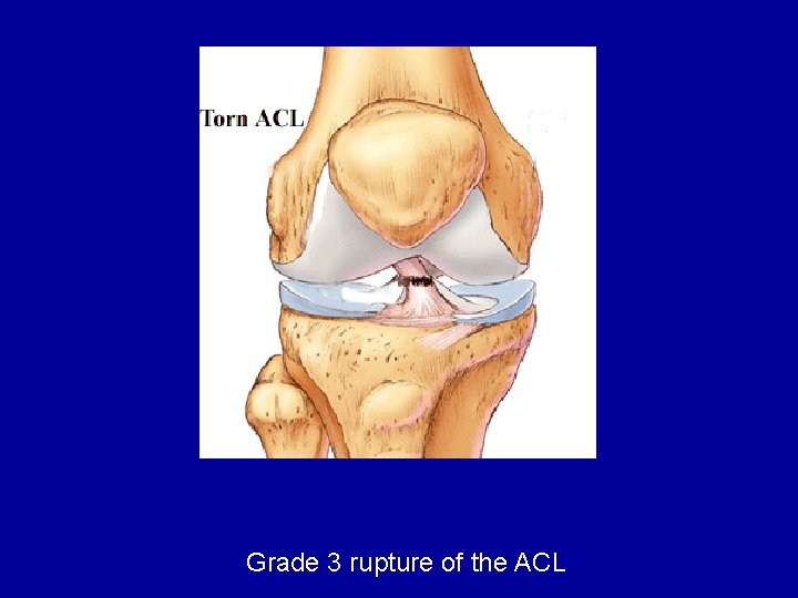 Grade 3 rupture of the ACL 