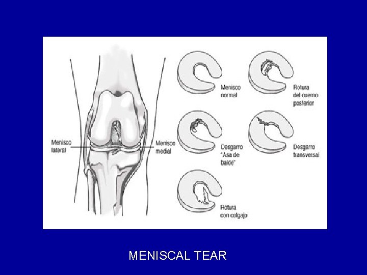 MENISCAL TEAR 