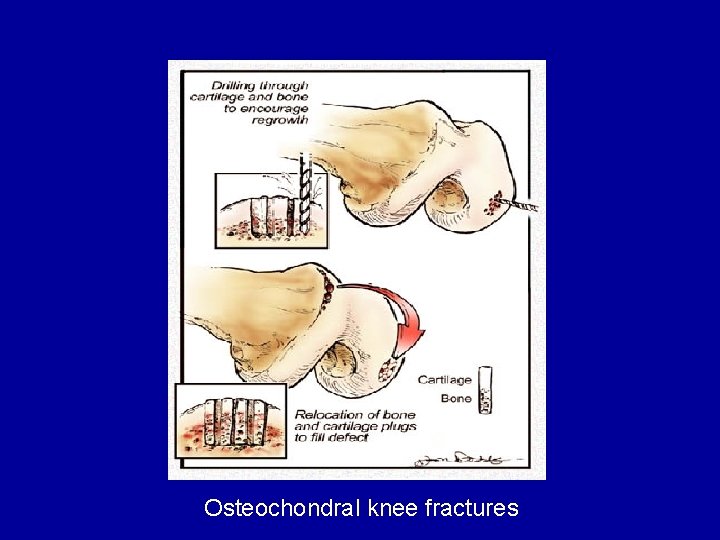 Osteochondral knee fractures 