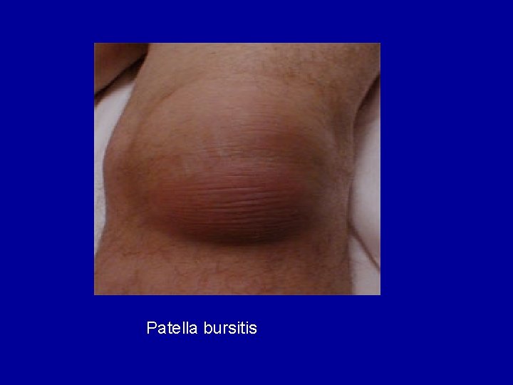 Patella bursitis 