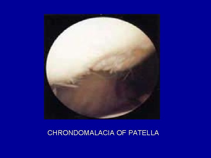 CHRONDOMALACIA OF PATELLA 