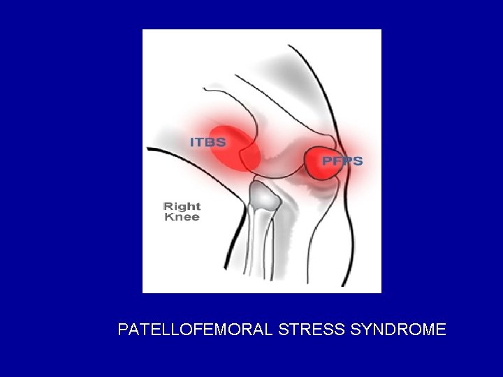 PATELLOFEMORAL STRESS SYNDROME 