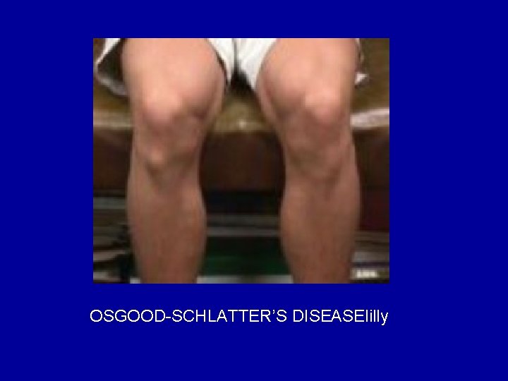 OSGOOD-SCHLATTER’S DISEASElilly 