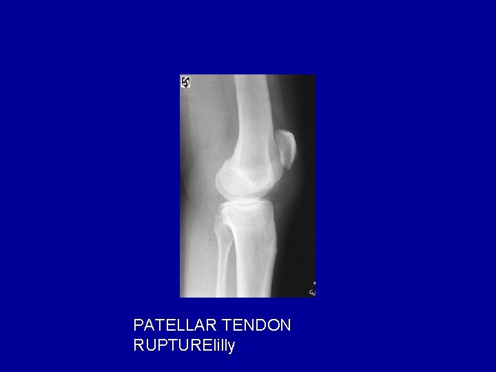 PATELLAR TENDON RUPTURElilly 