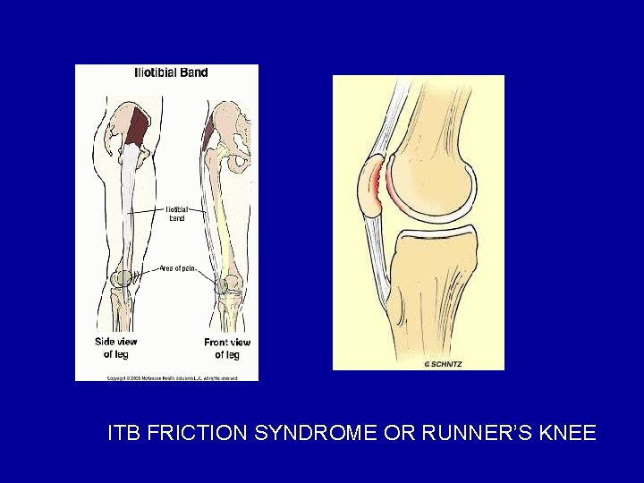 ITB FRICTION SYNDROME OR RUNNER’S KNEE 