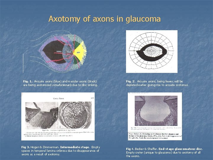 Axotomy of axons in glaucoma Fig. 1. Arcuate axons (blue) and macular axons (black)