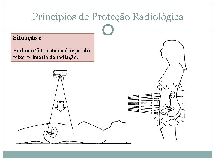 Princípios de Proteção Radiológica Situação 2: Embrião/feto está na direção do feixe primário de