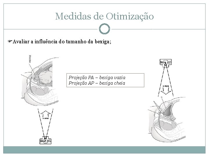 Medidas de Otimização Avaliar a influência do tamanho da bexiga; Projeção PA – bexiga