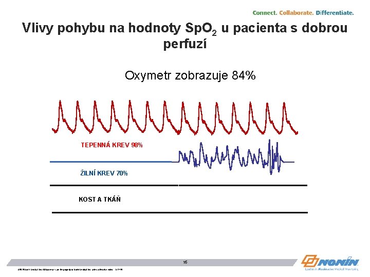 Vlivy pohybu na hodnoty Sp. O 2 u pacienta s dobrou perfuzí Oxymetr zobrazuje