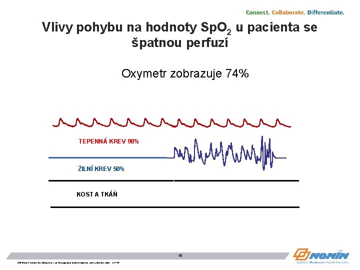 Vlivy pohybu na hodnoty Sp. O 2 u pacienta se špatnou perfuzí Oxymetr zobrazuje