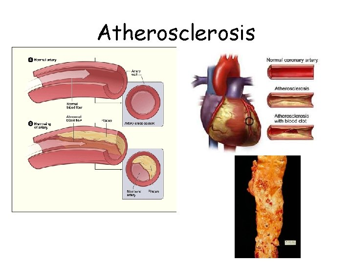 Atherosclerosis 