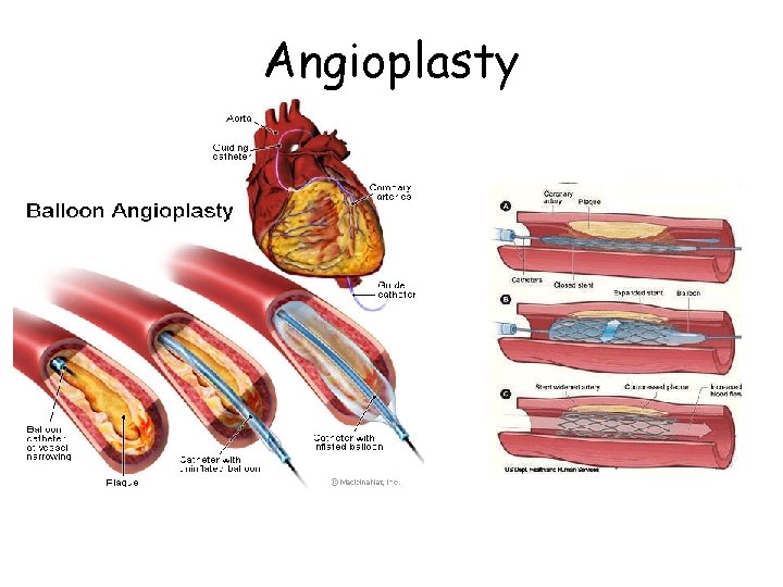 Angioplasty 