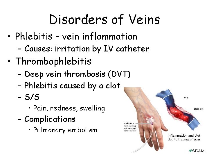 Disorders of Veins • Phlebitis – vein inflammation – Causes: irritation by IV catheter