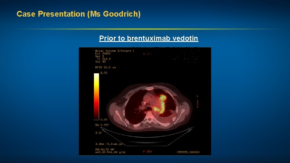 Case Presentation (Ms Goodrich) Prior to brentuximab vedotin 