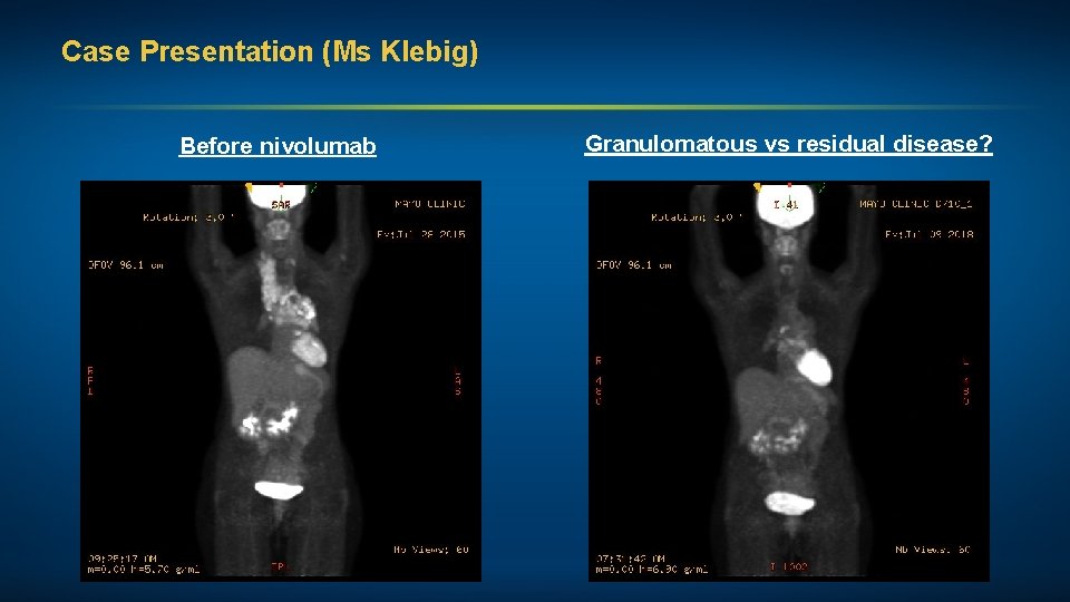 Case Presentation (Ms Klebig) Before nivolumab Granulomatous vs residual disease? 