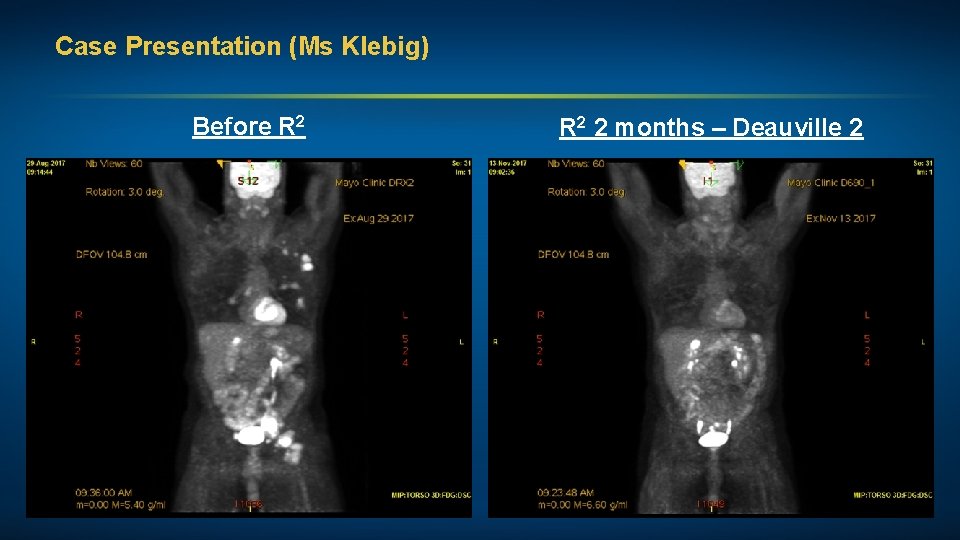 Case Presentation (Ms Klebig) Before R 2 2 months – Deauville 2 