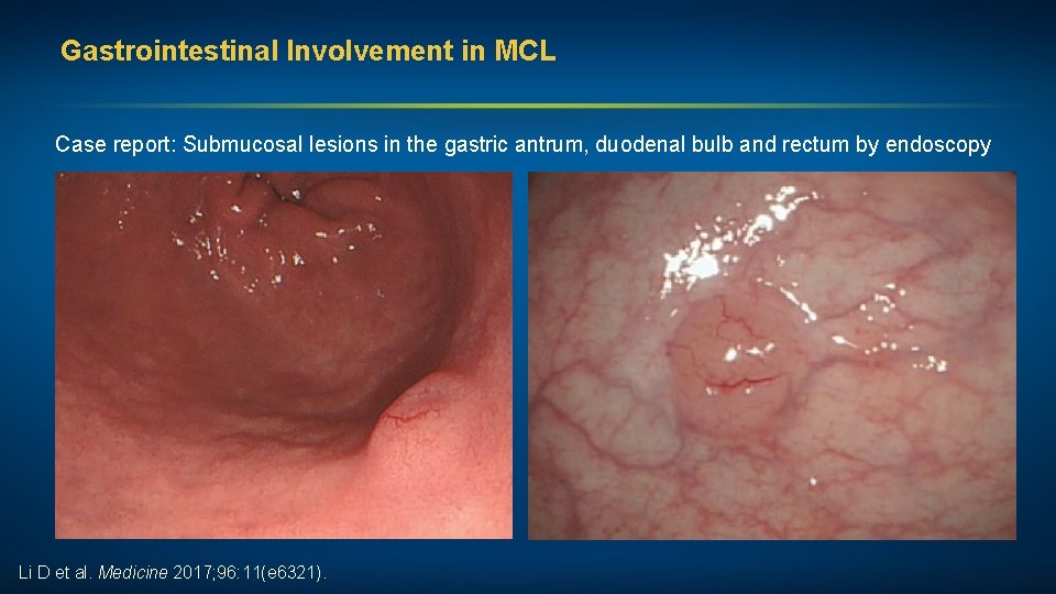 Gastrointestinal Involvement in MCL Case report: Submucosal lesions in the gastric antrum, duodenal bulb