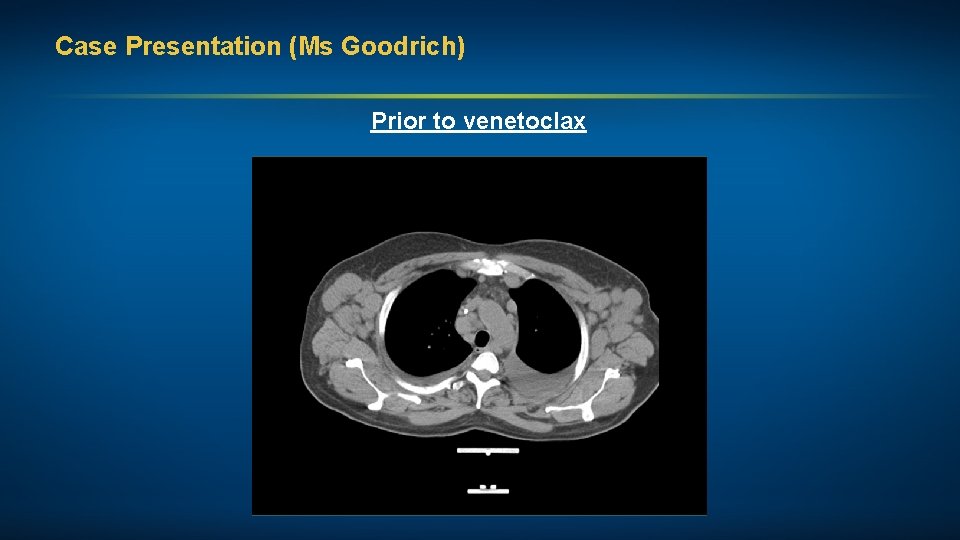 Case Presentation (Ms Goodrich) Prior to venetoclax 