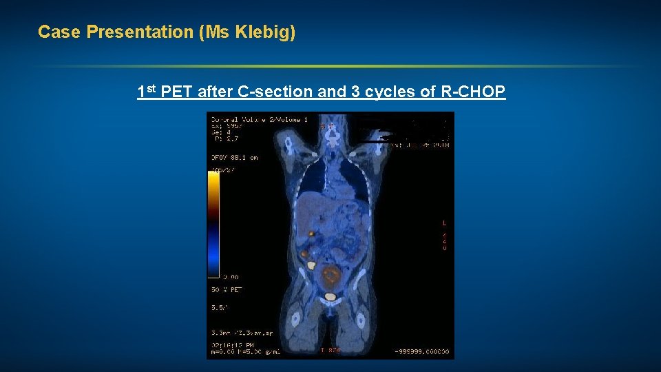 Case Presentation (Ms Klebig) 1 st PET after C-section and 3 cycles of R-CHOP