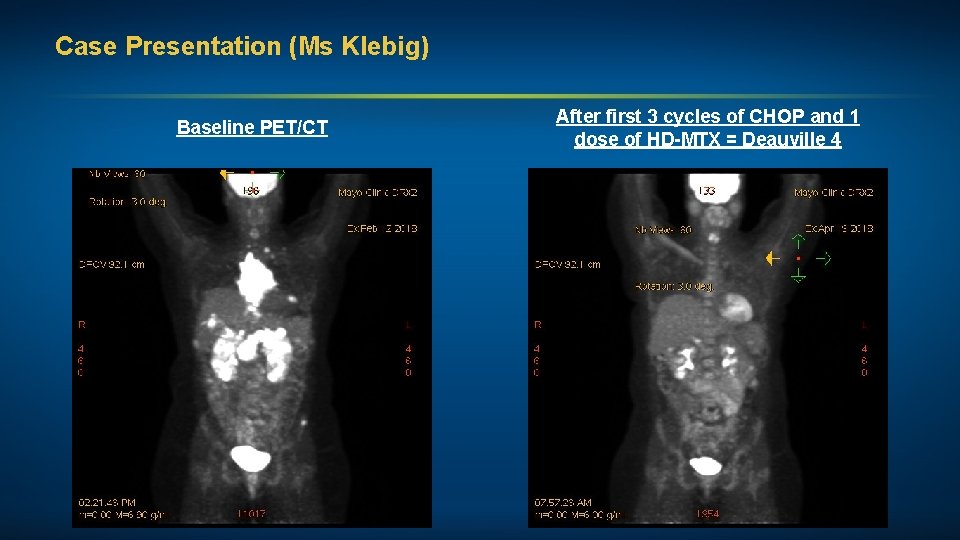 Case Presentation (Ms Klebig) Baseline PET/CT After first 3 cycles of CHOP and 1