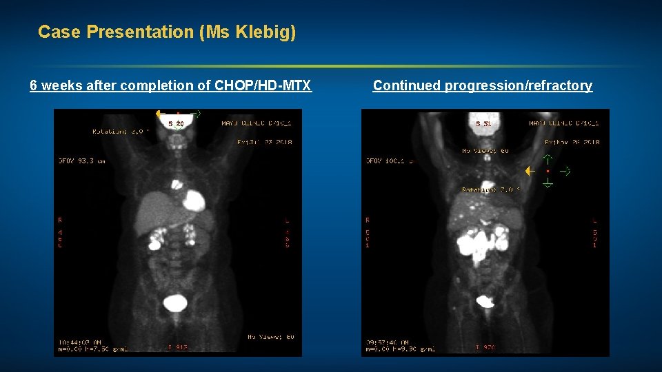 Case Presentation (Ms Klebig) 6 weeks after completion of CHOP/HD-MTX Continued progression/refractory 