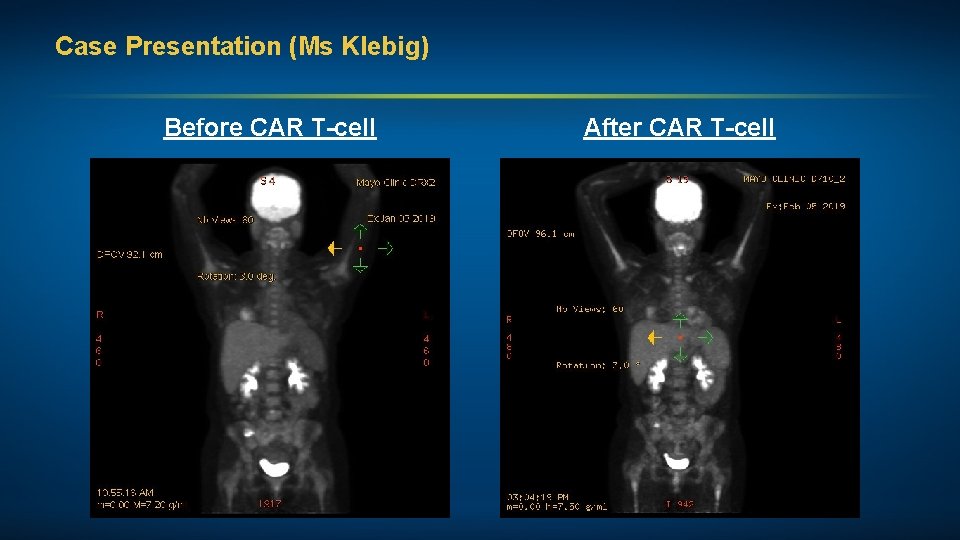 Case Presentation (Ms Klebig) Before CAR T-cell After CAR T-cell 